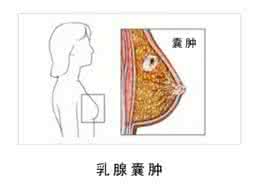 呼和浩特怎么预防乳腺囊肿