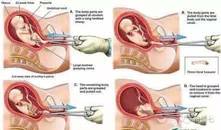 你知人流无痛,可知其不育风险?-钳刮术