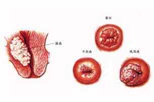 二度宫颈糜烂怎么治疗