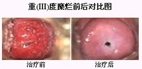 宫颈糜烂排卵期出血严重吗