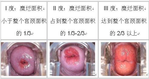 宫颈糜烂会引起腰疼吗?