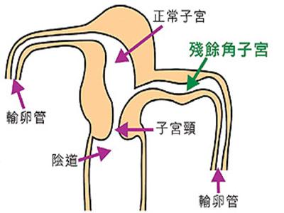 呼市人流手术引起不孕症的因素有哪些?