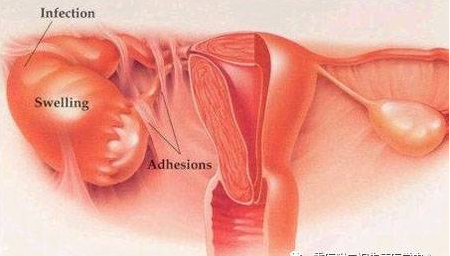 　　四、我国盆腔炎性疾病现状