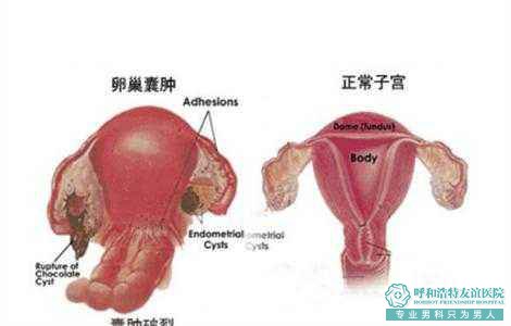 卵巢囊肿