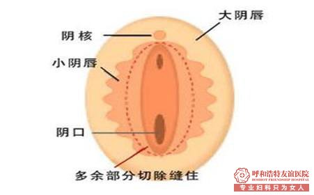 呼市切开闭锁的处女膜案例（1）